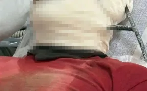 ¡Grave accidente en Oaxaca! obrero es empalado con varilla 